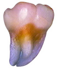 Tetracycline Md 3rdmolar BC.jpg